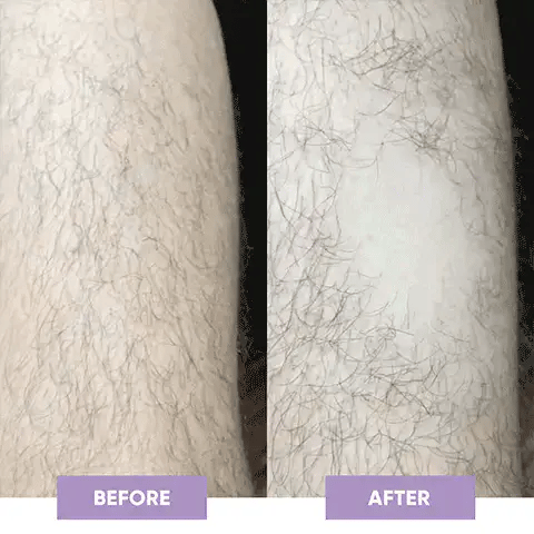 🔥 Magic Hair Eraser | Laser Removal At Home 🔥