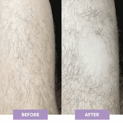 🔥 Magic Hair Eraser | Laser Removal At Home 🔥